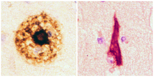 amyloid tangles